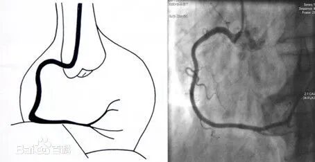 冠状动脉造影？没那么难，这样教你弄懂！