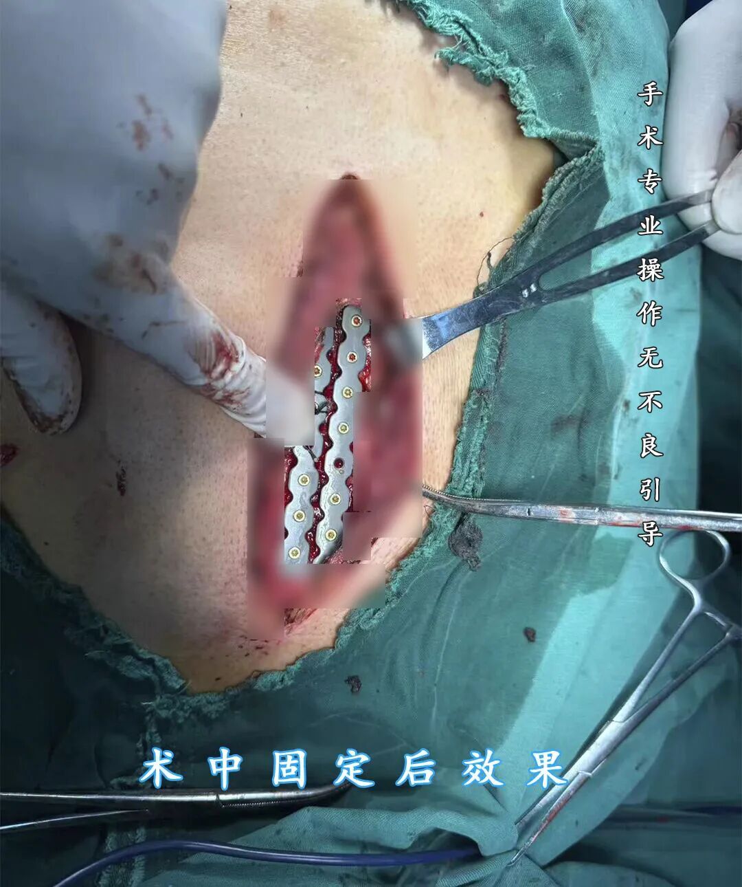 做手术台病床为什么63岁老人重伤后的“人生重启”：一台胸骨手术，让他术后一天走下病床_https://www.jmylbn.com_新闻资讯_第5张