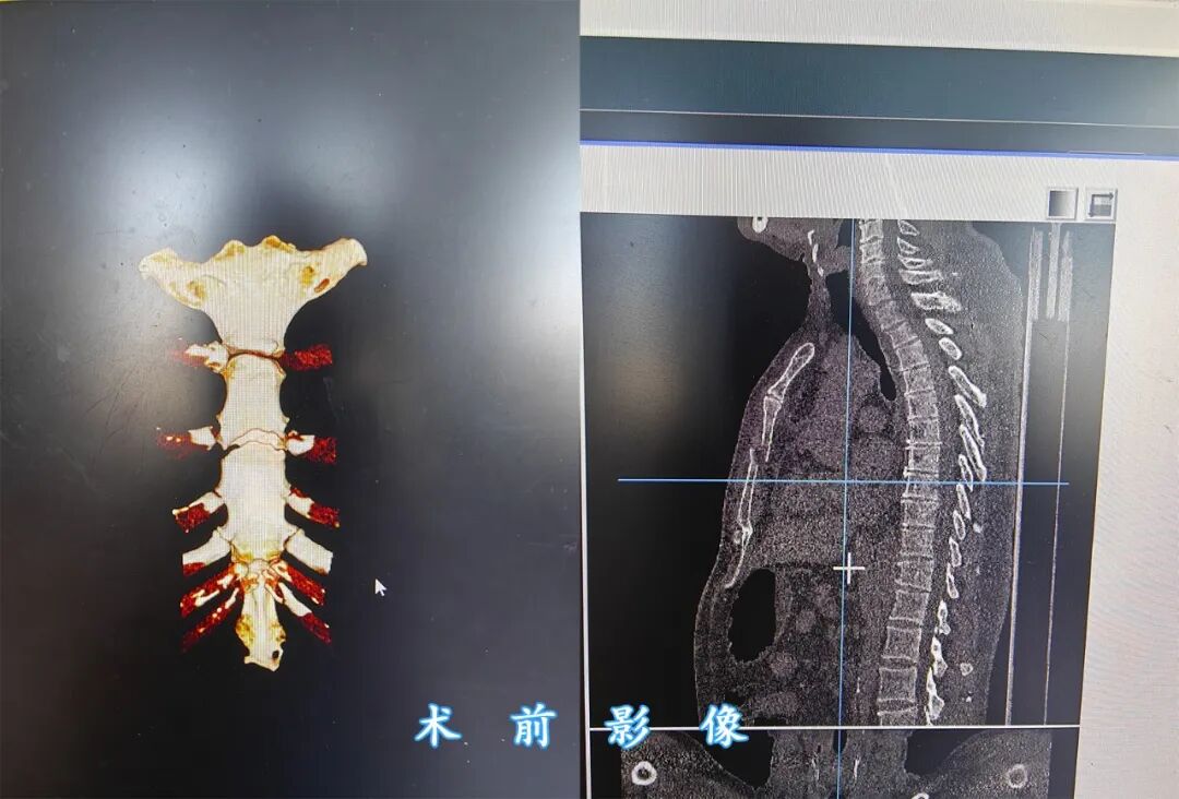 做手术台病床为什么63岁老人重伤后的“人生重启”：一台胸骨手术，让他术后一天走下病床_https://www.jmylbn.com_新闻资讯_第3张