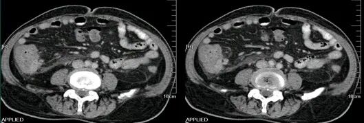 气腹管怎么接肠梗阻、肠套叠、气腹、肝挫伤、脾挫伤、肾挫伤、胰腺损伤、食管癌、胃肠肿瘤_https://www.jmylbn.com_新闻资讯_第50张