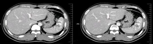 气腹管怎么接肠梗阻、肠套叠、气腹、肝挫伤、脾挫伤、肾挫伤、胰腺损伤、食管癌、胃肠肿瘤_https://www.jmylbn.com_新闻资讯_第27张