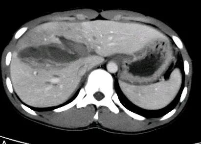 气腹管怎么接肠梗阻、肠套叠、气腹、肝挫伤、脾挫伤、肾挫伤、胰腺损伤、食管癌、胃肠肿瘤_https://www.jmylbn.com_新闻资讯_第20张