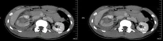 气腹管怎么接肠梗阻、肠套叠、气腹、肝挫伤、脾挫伤、肾挫伤、胰腺损伤、食管癌、胃肠肿瘤_https://www.jmylbn.com_新闻资讯_第31张