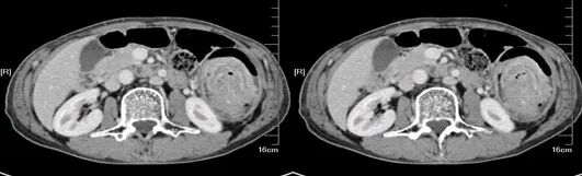 气腹管怎么接肠梗阻、肠套叠、气腹、肝挫伤、脾挫伤、肾挫伤、胰腺损伤、食管癌、胃肠肿瘤_https://www.jmylbn.com_新闻资讯_第14张