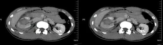 气腹管怎么接肠梗阻、肠套叠、气腹、肝挫伤、脾挫伤、肾挫伤、胰腺损伤、食管癌、胃肠肿瘤_https://www.jmylbn.com_新闻资讯_第30张