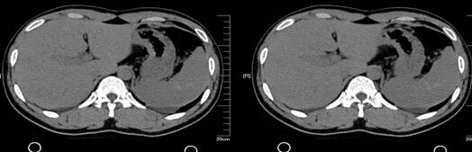 气腹管怎么接肠梗阻、肠套叠、气腹、肝挫伤、脾挫伤、肾挫伤、胰腺损伤、食管癌、胃肠肿瘤_https://www.jmylbn.com_新闻资讯_第24张