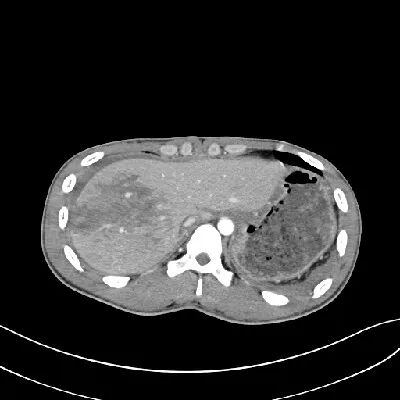 气腹管怎么接肠梗阻、肠套叠、气腹、肝挫伤、脾挫伤、肾挫伤、胰腺损伤、食管癌、胃肠肿瘤_https://www.jmylbn.com_新闻资讯_第22张