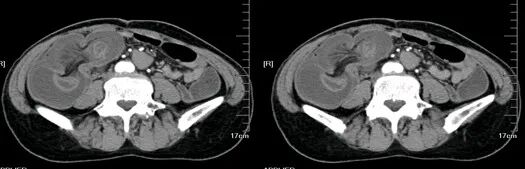 气腹管怎么接肠梗阻、肠套叠、气腹、肝挫伤、脾挫伤、肾挫伤、胰腺损伤、食管癌、胃肠肿瘤_https://www.jmylbn.com_新闻资讯_第10张