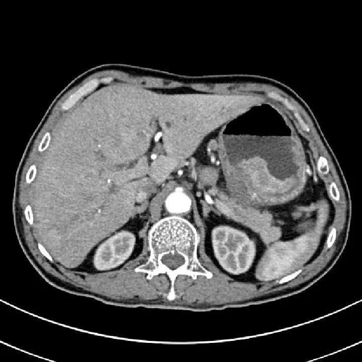 气腹管怎么接肠梗阻、肠套叠、气腹、肝挫伤、脾挫伤、肾挫伤、胰腺损伤、食管癌、胃肠肿瘤_https://www.jmylbn.com_新闻资讯_第42张
