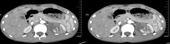 气腹管怎么接肠梗阻、肠套叠、气腹、肝挫伤、脾挫伤、肾挫伤、胰腺损伤、食管癌、胃肠肿瘤_https://www.jmylbn.com_新闻资讯_第28张