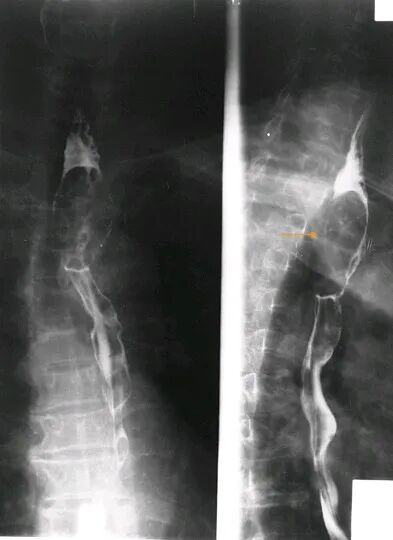 气腹管怎么接肠梗阻、肠套叠、气腹、肝挫伤、脾挫伤、肾挫伤、胰腺损伤、食管癌、胃肠肿瘤_https://www.jmylbn.com_新闻资讯_第36张