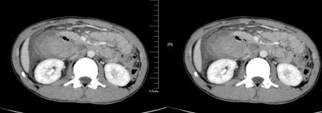 气腹管怎么接肠梗阻、肠套叠、气腹、肝挫伤、脾挫伤、肾挫伤、胰腺损伤、食管癌、胃肠肿瘤_https://www.jmylbn.com_新闻资讯_第34张