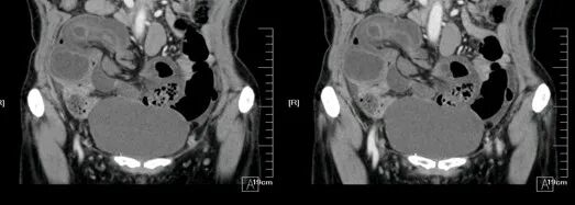 气腹管怎么接肠梗阻、肠套叠、气腹、肝挫伤、脾挫伤、肾挫伤、胰腺损伤、食管癌、胃肠肿瘤_https://www.jmylbn.com_新闻资讯_第12张