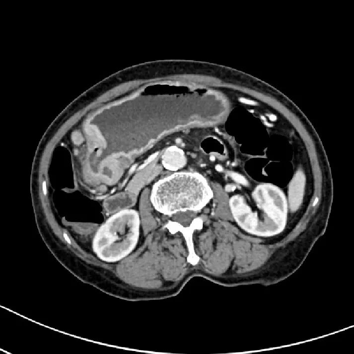 气腹管怎么接肠梗阻、肠套叠、气腹、肝挫伤、脾挫伤、肾挫伤、胰腺损伤、食管癌、胃肠肿瘤_https://www.jmylbn.com_新闻资讯_第43张