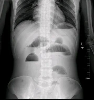 气腹管怎么接肠梗阻、肠套叠、气腹、肝挫伤、脾挫伤、肾挫伤、胰腺损伤、食管癌、胃肠肿瘤_https://www.jmylbn.com_新闻资讯_第3张