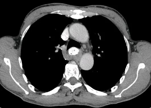 气腹管怎么接肠梗阻、肠套叠、气腹、肝挫伤、脾挫伤、肾挫伤、胰腺损伤、食管癌、胃肠肿瘤_https://www.jmylbn.com_新闻资讯_第39张