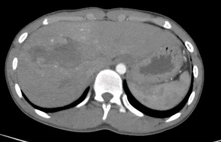 气腹管怎么接肠梗阻、肠套叠、气腹、肝挫伤、脾挫伤、肾挫伤、胰腺损伤、食管癌、胃肠肿瘤_https://www.jmylbn.com_新闻资讯_第19张