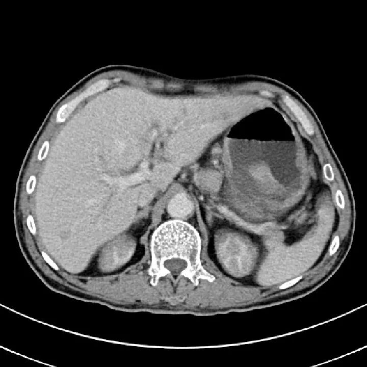 气腹管怎么接肠梗阻、肠套叠、气腹、肝挫伤、脾挫伤、肾挫伤、胰腺损伤、食管癌、胃肠肿瘤_https://www.jmylbn.com_新闻资讯_第40张