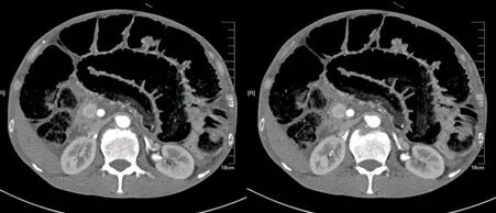 气腹管怎么接肠梗阻、肠套叠、气腹、肝挫伤、脾挫伤、肾挫伤、胰腺损伤、食管癌、胃肠肿瘤_https://www.jmylbn.com_新闻资讯_第7张