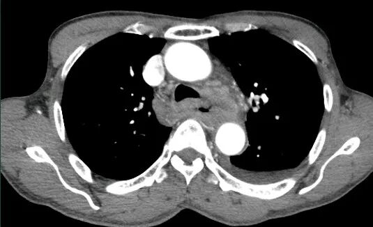 气腹管怎么接肠梗阻、肠套叠、气腹、肝挫伤、脾挫伤、肾挫伤、胰腺损伤、食管癌、胃肠肿瘤_https://www.jmylbn.com_新闻资讯_第37张