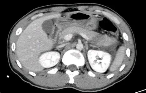 气腹管怎么接肠梗阻、肠套叠、气腹、肝挫伤、脾挫伤、肾挫伤、胰腺损伤、食管癌、胃肠肿瘤_https://www.jmylbn.com_新闻资讯_第32张