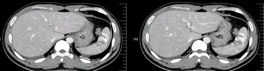 气腹管怎么接肠梗阻、肠套叠、气腹、肝挫伤、脾挫伤、肾挫伤、胰腺损伤、食管癌、胃肠肿瘤_https://www.jmylbn.com_新闻资讯_第26张