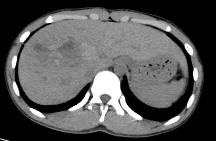 气腹管怎么接肠梗阻、肠套叠、气腹、肝挫伤、脾挫伤、肾挫伤、胰腺损伤、食管癌、胃肠肿瘤_https://www.jmylbn.com_新闻资讯_第18张