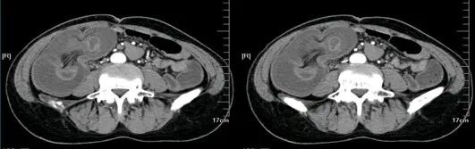 气腹管怎么接肠梗阻、肠套叠、气腹、肝挫伤、脾挫伤、肾挫伤、胰腺损伤、食管癌、胃肠肿瘤_https://www.jmylbn.com_新闻资讯_第9张