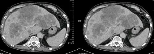 气腹管怎么接肠梗阻、肠套叠、气腹、肝挫伤、脾挫伤、肾挫伤、胰腺损伤、食管癌、胃肠肿瘤_https://www.jmylbn.com_新闻资讯_第51张