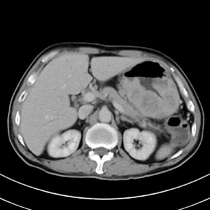 气腹管怎么接肠梗阻、肠套叠、气腹、肝挫伤、脾挫伤、肾挫伤、胰腺损伤、食管癌、胃肠肿瘤_https://www.jmylbn.com_新闻资讯_第41张