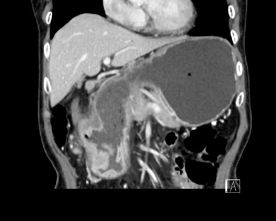 气腹管怎么接肠梗阻、肠套叠、气腹、肝挫伤、脾挫伤、肾挫伤、胰腺损伤、食管癌、胃肠肿瘤_https://www.jmylbn.com_新闻资讯_第45张