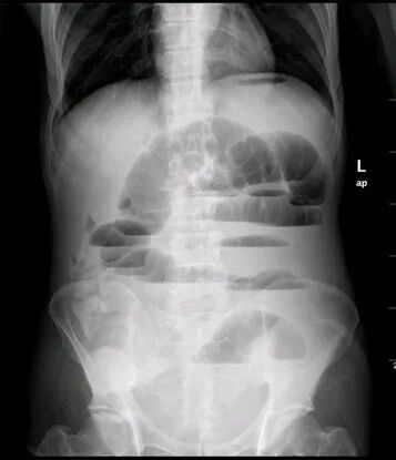 气腹管怎么接肠梗阻、肠套叠、气腹、肝挫伤、脾挫伤、肾挫伤、胰腺损伤、食管癌、胃肠肿瘤_https://www.jmylbn.com_新闻资讯_第4张