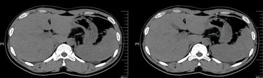 气腹管怎么接肠梗阻、肠套叠、气腹、肝挫伤、脾挫伤、肾挫伤、胰腺损伤、食管癌、胃肠肿瘤_https://www.jmylbn.com_新闻资讯_第25张