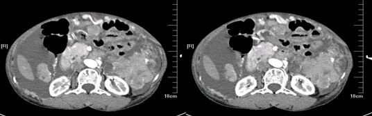 气腹管怎么接肠梗阻、肠套叠、气腹、肝挫伤、脾挫伤、肾挫伤、胰腺损伤、食管癌、胃肠肿瘤_https://www.jmylbn.com_新闻资讯_第48张