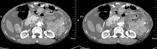 气腹管怎么接肠梗阻、肠套叠、气腹、肝挫伤、脾挫伤、肾挫伤、胰腺损伤、食管癌、胃肠肿瘤_https://www.jmylbn.com_新闻资讯_第47张