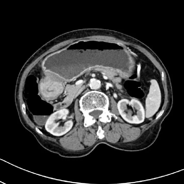 气腹管怎么接肠梗阻、肠套叠、气腹、肝挫伤、脾挫伤、肾挫伤、胰腺损伤、食管癌、胃肠肿瘤_https://www.jmylbn.com_新闻资讯_第44张