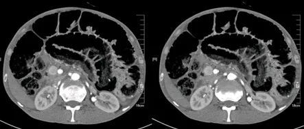 气腹管怎么接肠梗阻、肠套叠、气腹、肝挫伤、脾挫伤、肾挫伤、胰腺损伤、食管癌、胃肠肿瘤_https://www.jmylbn.com_新闻资讯_第8张