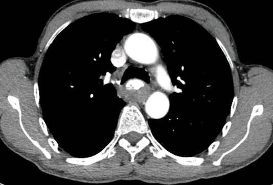 气腹管怎么接肠梗阻、肠套叠、气腹、肝挫伤、脾挫伤、肾挫伤、胰腺损伤、食管癌、胃肠肿瘤_https://www.jmylbn.com_新闻资讯_第38张