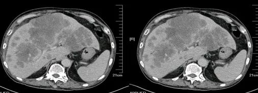 气腹管怎么接肠梗阻、肠套叠、气腹、肝挫伤、脾挫伤、肾挫伤、胰腺损伤、食管癌、胃肠肿瘤_https://www.jmylbn.com_新闻资讯_第52张