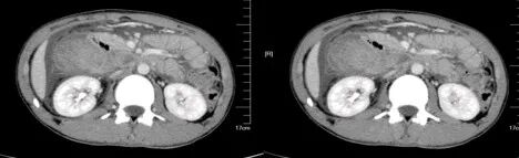 气腹管怎么接肠梗阻、肠套叠、气腹、肝挫伤、脾挫伤、肾挫伤、胰腺损伤、食管癌、胃肠肿瘤_https://www.jmylbn.com_新闻资讯_第33张