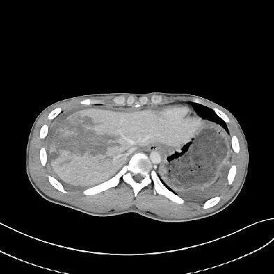 气腹管怎么接肠梗阻、肠套叠、气腹、肝挫伤、脾挫伤、肾挫伤、胰腺损伤、食管癌、胃肠肿瘤_https://www.jmylbn.com_新闻资讯_第23张