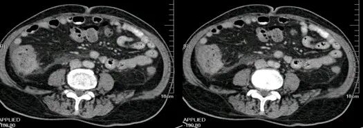 气腹管怎么接肠梗阻、肠套叠、气腹、肝挫伤、脾挫伤、肾挫伤、胰腺损伤、食管癌、胃肠肿瘤_https://www.jmylbn.com_新闻资讯_第49张