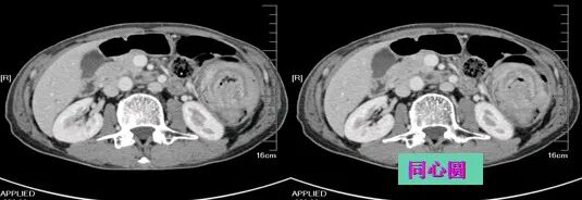 气腹管怎么接肠梗阻、肠套叠、气腹、肝挫伤、脾挫伤、肾挫伤、胰腺损伤、食管癌、胃肠肿瘤_https://www.jmylbn.com_新闻资讯_第13张