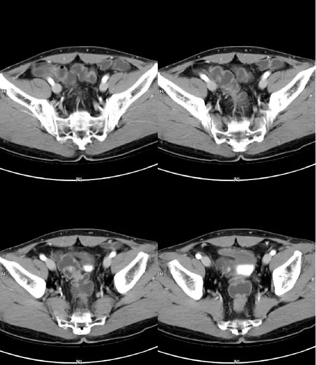 气腹管怎么接肠梗阻、肠套叠、气腹、肝挫伤、脾挫伤、肾挫伤、胰腺损伤、食管癌、胃肠肿瘤_https://www.jmylbn.com_新闻资讯_第46张