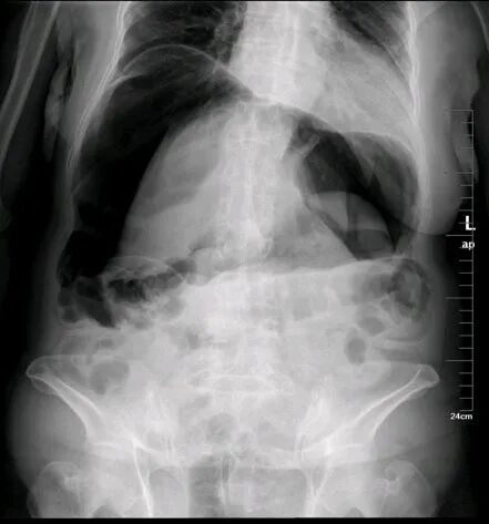 气腹管怎么接肠梗阻、肠套叠、气腹、肝挫伤、脾挫伤、肾挫伤、胰腺损伤、食管癌、胃肠肿瘤_https://www.jmylbn.com_新闻资讯_第15张