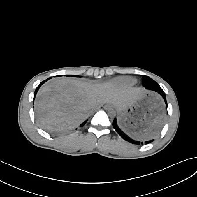 气腹管怎么接肠梗阻、肠套叠、气腹、肝挫伤、脾挫伤、肾挫伤、胰腺损伤、食管癌、胃肠肿瘤_https://www.jmylbn.com_新闻资讯_第21张