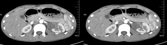 气腹管怎么接肠梗阻、肠套叠、气腹、肝挫伤、脾挫伤、肾挫伤、胰腺损伤、食管癌、胃肠肿瘤_https://www.jmylbn.com_新闻资讯_第29张