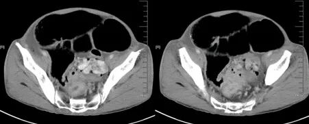 气腹管怎么接肠梗阻、肠套叠、气腹、肝挫伤、脾挫伤、肾挫伤、胰腺损伤、食管癌、胃肠肿瘤_https://www.jmylbn.com_新闻资讯_第6张
