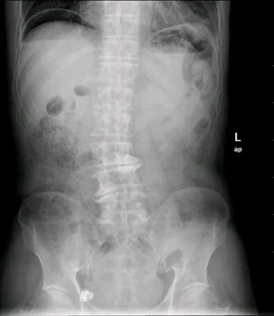 气腹管怎么接肠梗阻、肠套叠、气腹、肝挫伤、脾挫伤、肾挫伤、胰腺损伤、食管癌、胃肠肿瘤_https://www.jmylbn.com_新闻资讯_第17张