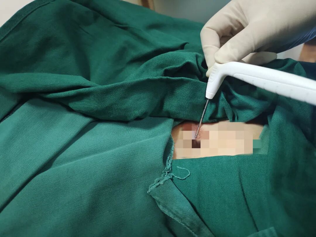 氦氩刀是什么【航医说医】“冻死”肿瘤--氩氦刀冷冻消融技术，肿瘤治疗新选择_https://www.jmylbn.com_新闻资讯_第5张